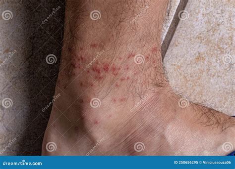 Allergic Reactions To Tick Bites Stock Image Image Of Cajennense