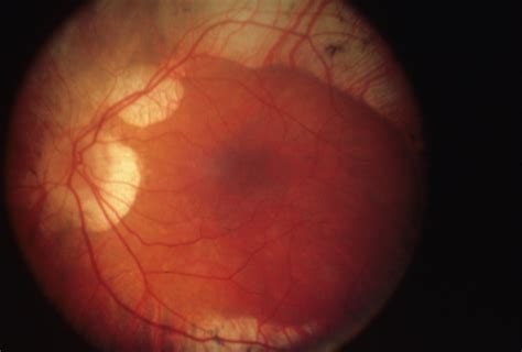 Gyrate Atrophy Hereditary Ocular Diseases