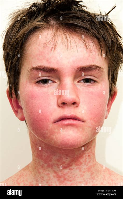 Allergic Skin Rash On Face