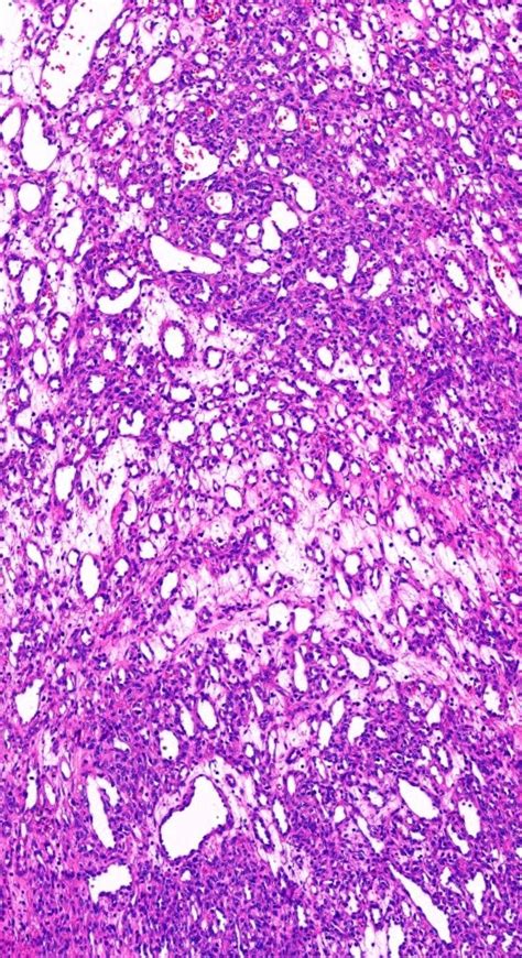 Pathology Of Pyogenic Granuloma Pathology Blog