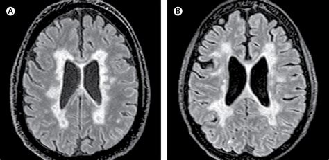 New Ms Subtype Shows Absence Of Cerebral White Matter Demyelination