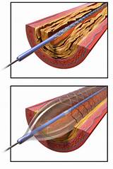 A Balloon Angioplasty Is Used To Photos