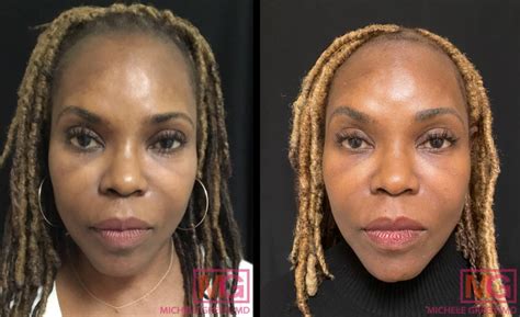 African American Skin Treatment And Dermatology Nyc Dr Michele Green M