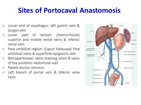 Portacaval Anastomosis Diagram