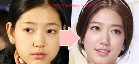 Park Shin Hye Plastic Surgery Before And After 2022