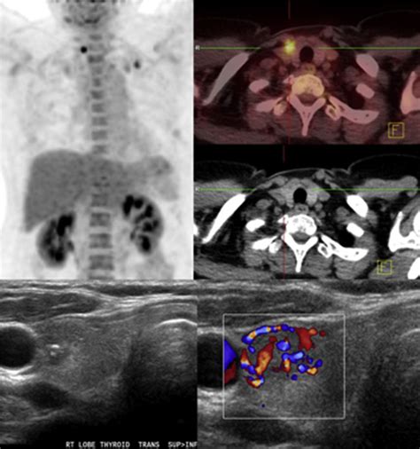 Ultrasound Stratification Of The FDG Avid Thyroid Nodule Clinical Radiology