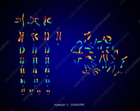 Turner S Syndrome Karyotype Stock Image C022 0561 Science Photo
