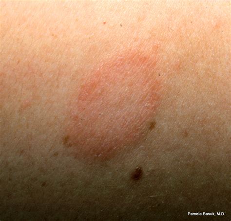 Herald Patch Pityriasis Rosea Causes Acquire