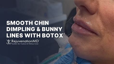 Botox For Chin Dimples And Bunny Lines Youtube