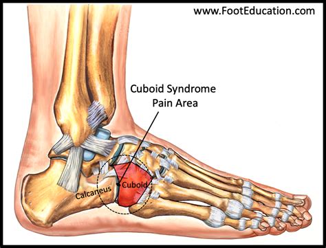 Cuboid Syndrome Footeducation