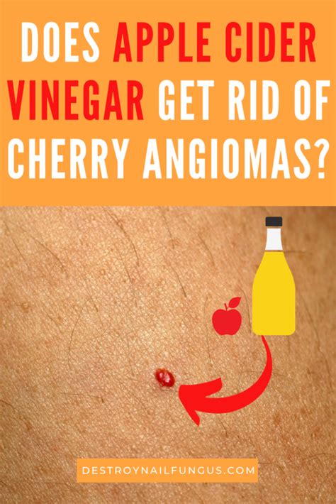 Cherry Angioma Removal Apple Cider Vinegar And Other Home Remedies