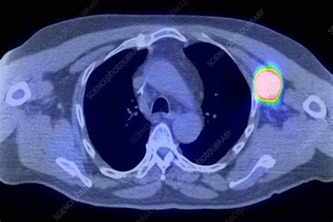 Non Hodgkins Lymphoma Ct And Pet Scans Stock Image C0017961