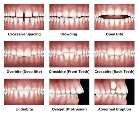 How long should you wear braces? Orthodontics / Braces