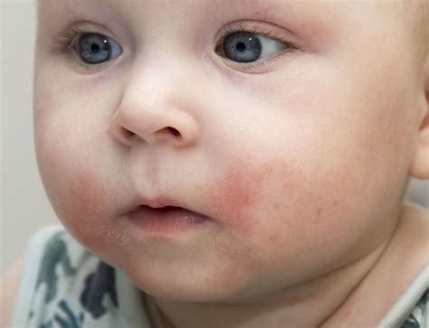 Types Of Baby Rashes Artofit