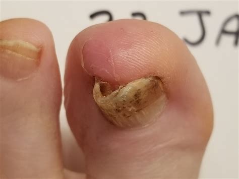 Run With Perseverance A Tale Of Two Toenails How To Fix Runners Toenails