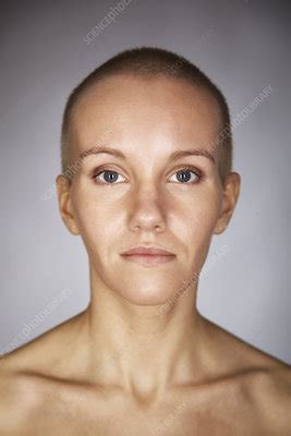 Nude Woman With Shaved Head Stock Image F007 0646 Science Photo