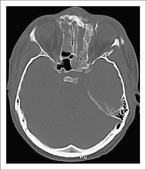 CT scan showing fracture of the skull base at the orbital ...