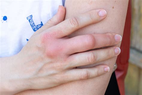 Gebruik Uitgang Functie Swollen Knuckle On Ring Finger Gewoon Overlopen