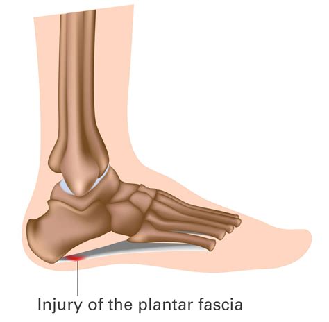 Plantar Fasciitis Mr Daniel Goldbloom Melbourne