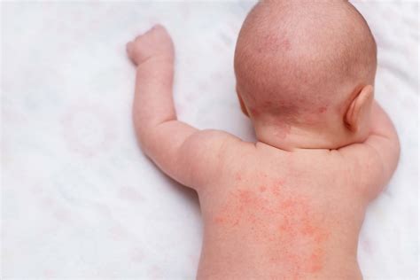 Weeping Eczema In Babies Eczema In Babies Children And Teenagers