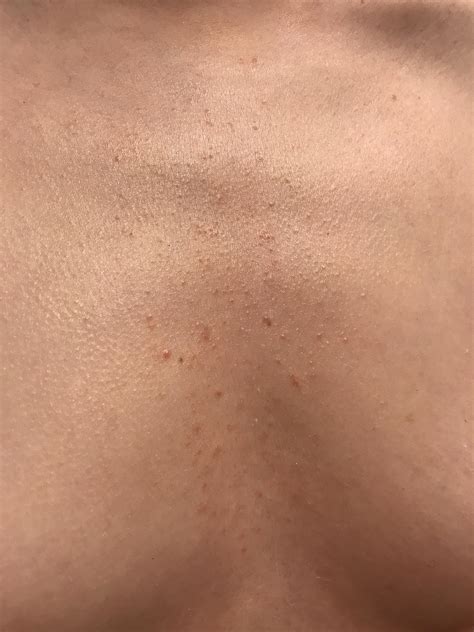 Skin Concerns Weird Chest Acnerash Please Help Me Fix This