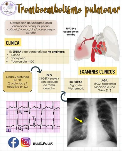 Tromboembolismo Pulmonar Resumen MED RULES UDocz