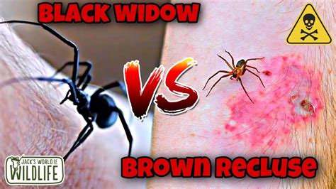 Which Bite Is Worse Black Widow Vs Brown Recluse Youtube