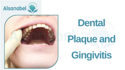 Understanding Gingivitis Causes And Symptoms 2024 مركز السنابل للأسنان