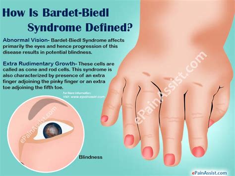 Bardet Biedl Syndrome Bbs Causes Symptoms Diagnosis Treatment Prognosis