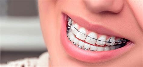 ¿necesitas Una Ortodoncia Clínica Dental Salud