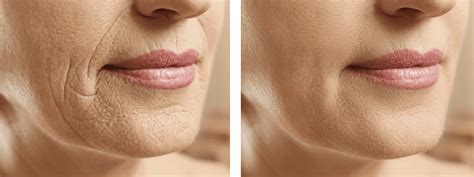 Before After Laser Treatment For Wrinkles Photo Gallery The Spa At Spring Ridge