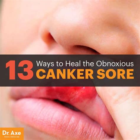 13 Ways To Heal The Canker Sore Dr Axe