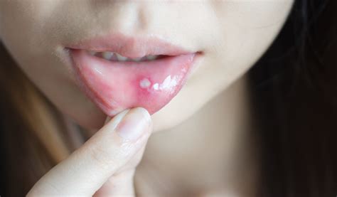 Aftele bucale Ce sunt Cauze și tratament Arial Dent