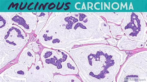 Primary Cutaneous Mucinous Carcinoma And Endocrine Mucin Producing Sweat
