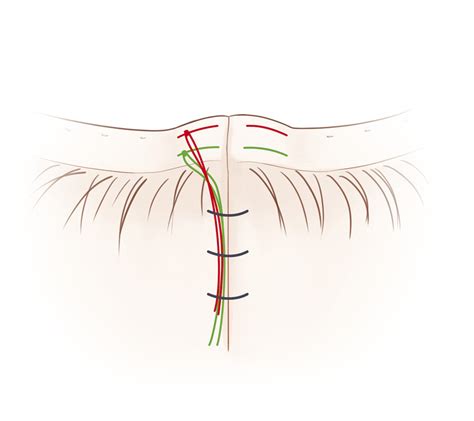 4 Eyelid Margin Laceration Repair Ento Key