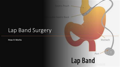 Lap Band Surgery How It Works Youtube