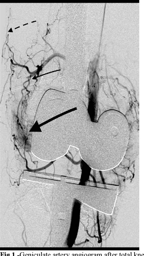 Figure 1 From Genicular Artery Embolization For The Treatment Of Knee
