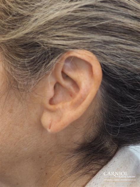 Earlobe Surgery Before And After Gallery