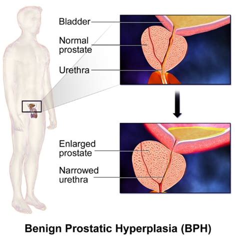 Rezum A Breakthrough Treatment For Bhp Shrinking Swollen Prostates With Steam Gilmore Health News