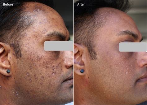 Post Inflammatory Hyperpigmentation Treatment And Prevention