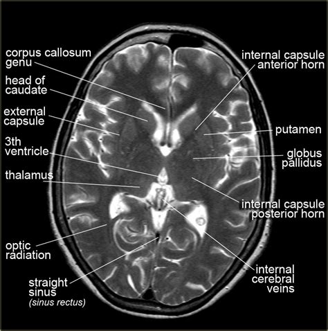Documents similar to ct brain anatomy. The Radiology Assistant : Brain Anatomy