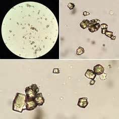 Most uric acid dissolves in blood and travels to the kidneys, where it passes out in urine. Uric acid crystals from urate stones. Aid. IBD. Colectomy ...