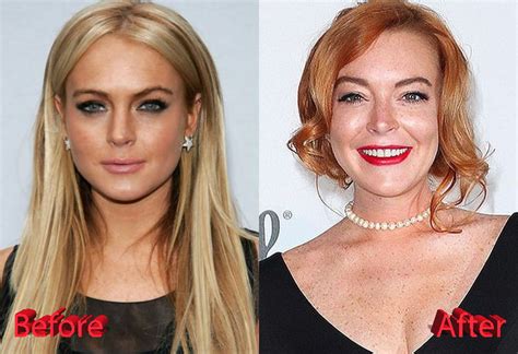 Lindsay Lohan Plastic Surgery Is She Done With It