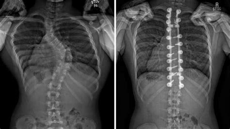 Mayo Clinic Minute Correcting The Curve With Scoliosis Surgery