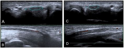 Ultrasonographic Evaluation Of Two Different Patients With Mild Cts