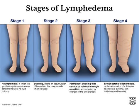Ask The Doctors Lymphedema Symptoms And Causes With Doctors Sacks And