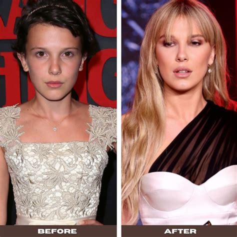Did Millie Bobby Brown Get Plastic Surgery
