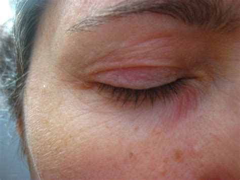 Perioral Dermatitis Eyes Pictures Photos