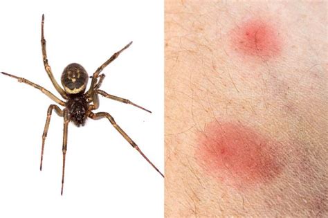 Identifying Spider Bites