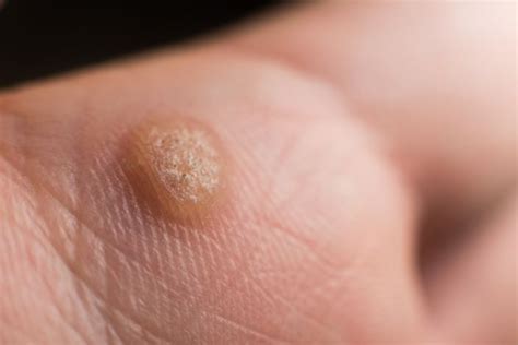 How To Identify A Wart Us Dermatology Partners